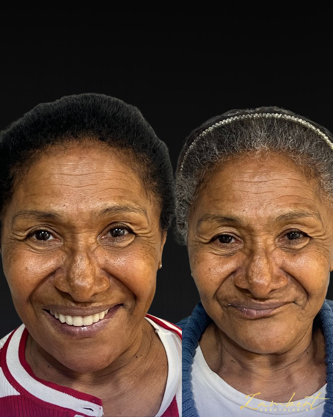 Lente de Contato Dental